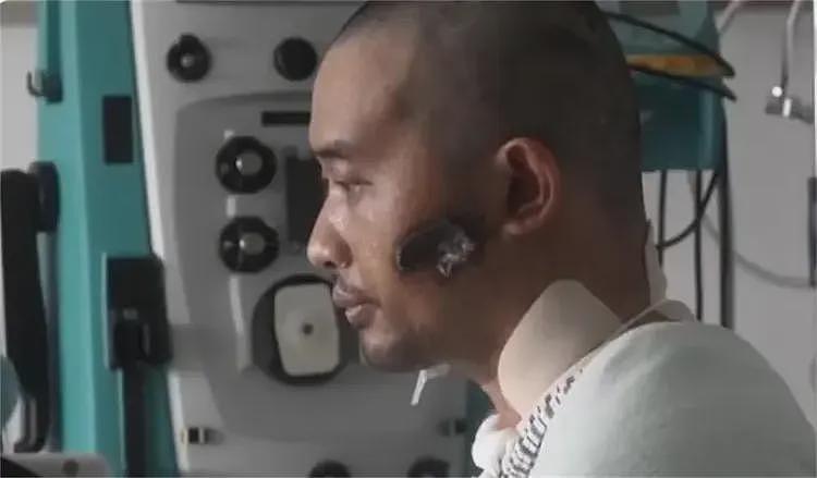 全身溃烂生不如死,暴瘦40斤,武汉首批新冠患者如今过得如何?(组图) - 25