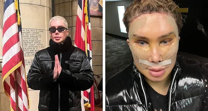 为变成韩国人，英国男子疯狂整容，做丁丁缩小技术甚至变成女人！如今，他却想变回最初...（组图） - 20