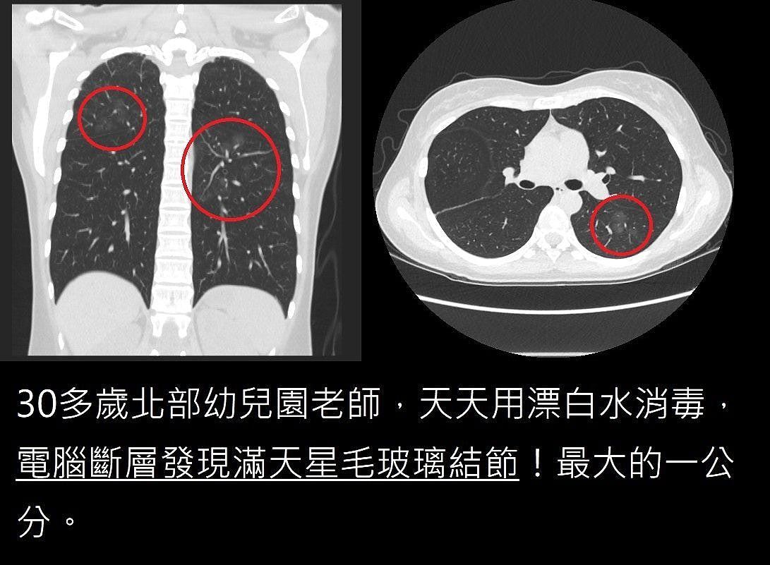 漂白水杀菌变杀肺?30岁幼师扫出10颗肺结节,医吁慎防漂白水毒害(组图) - 2