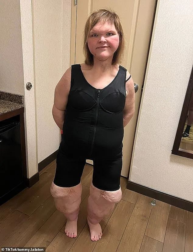 励志!美国千斤姐妹已暴瘦!姐狂减450斤,妹也掉160斤!这对比惊呆了...(组图) - 5