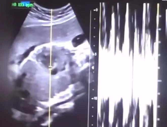 韩国女子怀孕9月堕胎！医生直接剖腹产再把娃塞冰箱？警方靠她揪出幕后黑产链...（组图） - 5