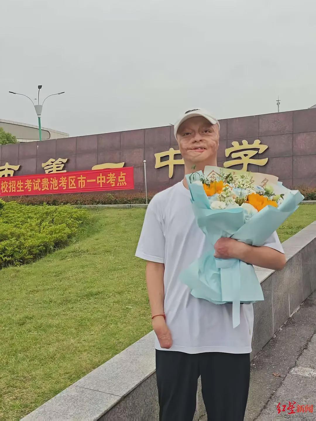 “烧伤男孩“664分被东南大学录取:曾经历23次手术(组图) - 1