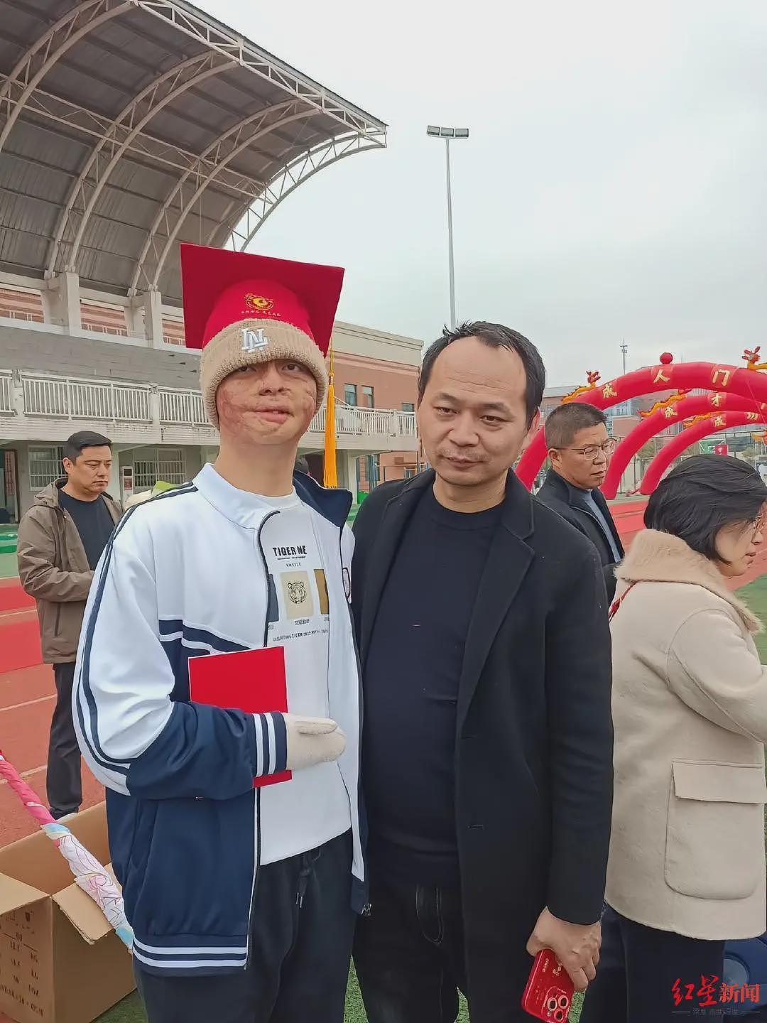 “烧伤男孩“664分被东南大学录取:曾经历23次手术(组图) - 3