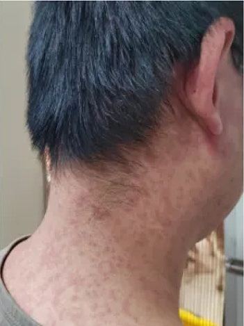 佛山曝光多张基孔肯雅热患者皮疹照片：部分或发展为严重并发症（组图） - 2