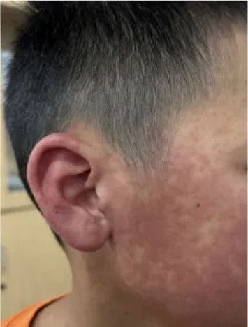 佛山曝光多张基孔肯雅热患者皮疹照片：部分或发展为严重并发症（组图） - 1