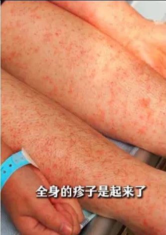 佛山曝光多张基孔肯雅热患者皮疹照片：部分或发展为严重并发症（组图） - 4