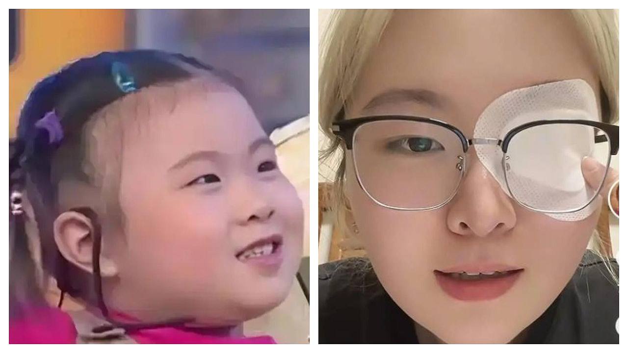 发病率仅0.03%!中国知名童星患罕见“美女病”,叹25岁右眼已失明(组图) - 1