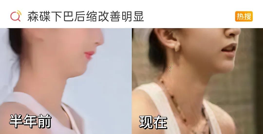 田亮17岁女儿森碟近照曝光！矫正后颜值大变，原来这一细节不重视，孩子真会变丑...（组图） - 3