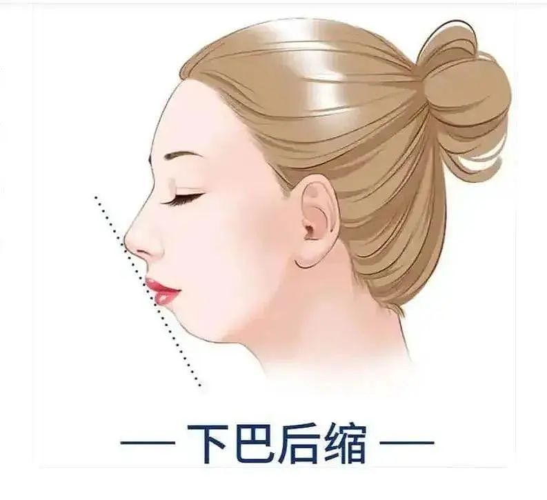 田亮17岁女儿森碟近照曝光！矫正后颜值大变，原来这一细节不重视，孩子真会变丑...（组图） - 14