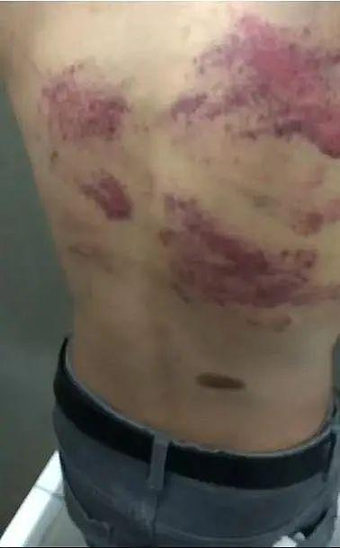 21岁被骗缅甸小伙获救,曾发消息求救“被打得耳膜穿孔”(组图) - 5
