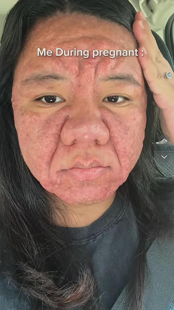她孕前还像娃娃脸大学生，孕后直接毁容，全脸长痘！这是一个人（组图） - 3