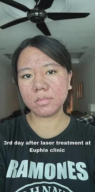 她孕前还像娃娃脸大学生，孕后直接毁容，全脸长痘！这是一个人（组图） - 15