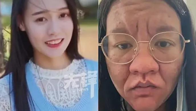 她孕前还像娃娃脸大学生，孕后直接毁容，全脸长痘！这是一个人（组图） - 24