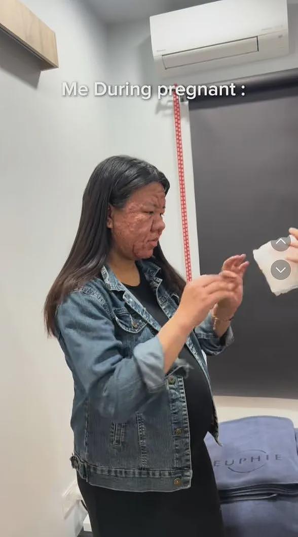 她孕前还像娃娃脸大学生，孕后直接毁容，全脸长痘！这是一个人（组图） - 4