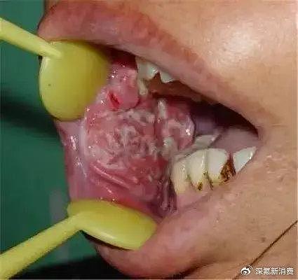 【涨知识】这个与砒霜同级的致癌物,却有1亿国人在嚼(组图) - 7