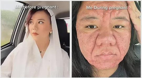 她孕前还像娃娃脸大学生，孕后直接毁容，全脸长痘！这是一个人（组图） - 5