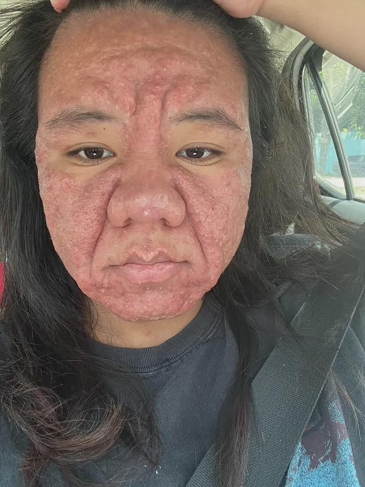 她孕前还像娃娃脸大学生，孕后直接毁容，全脸长痘！这是一个人（组图） - 10