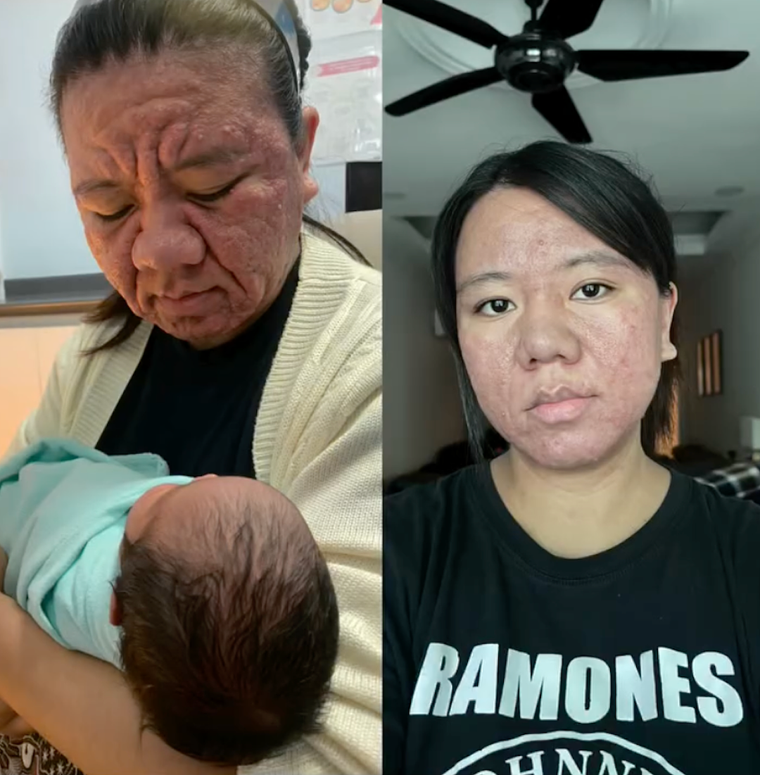 妹纸怀孕前青春靓丽，怀孕后直接毁容，鼻子变大全脸长疮发炎，看起来老了几十岁？（组图） - 11