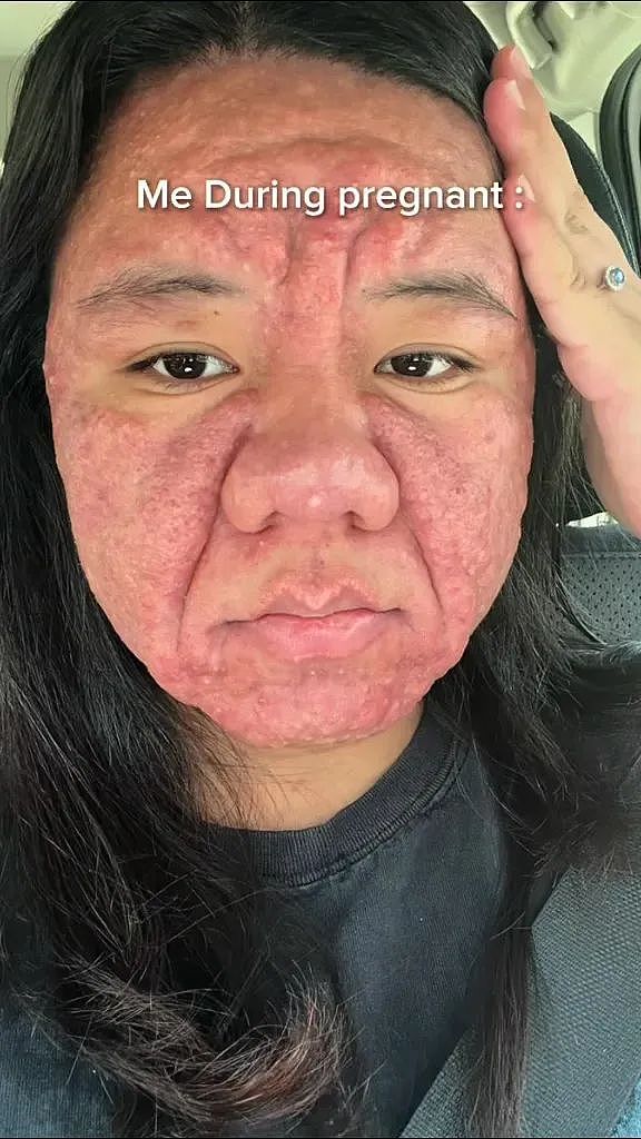 妹纸怀孕前青春靓丽，怀孕后直接毁容，鼻子变大全脸长疮发炎，看起来老了几十岁？（组图） - 6