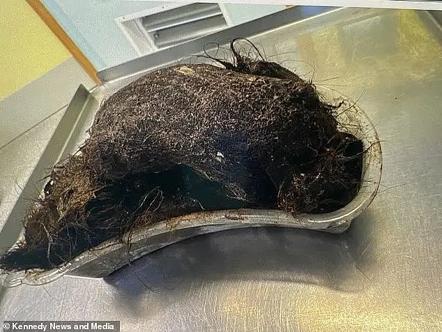 女孩长期腹痛，竟在胃里发现西瓜大头发球？！梦中吃头发，自己不知道...（组图） - 1