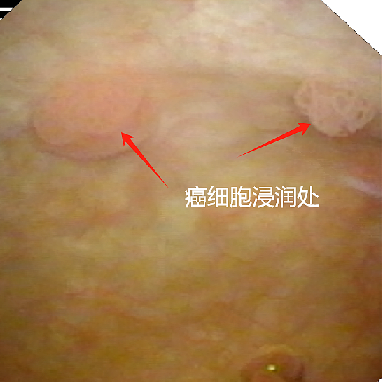 不痛不痒，要切除重要器官？男子悔惨：这里长肿块90%是恶性癌（组图） - 2