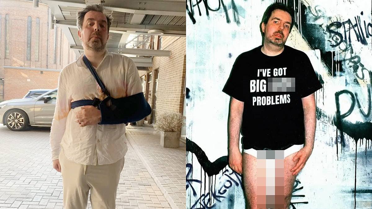 英国男子拥“全球最大阴茎”却惨事不断，“洗澡看不到脚”致滑倒断手（组图） - 1