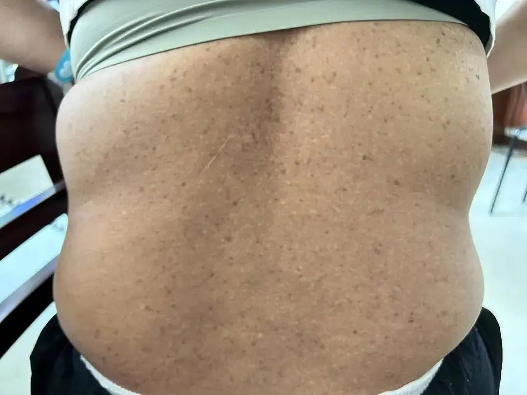 越来越黑!杭州女子脖子总洗不干净,竟是中了“砒霜”之毒!医生:她有个习惯……(组图) - 2