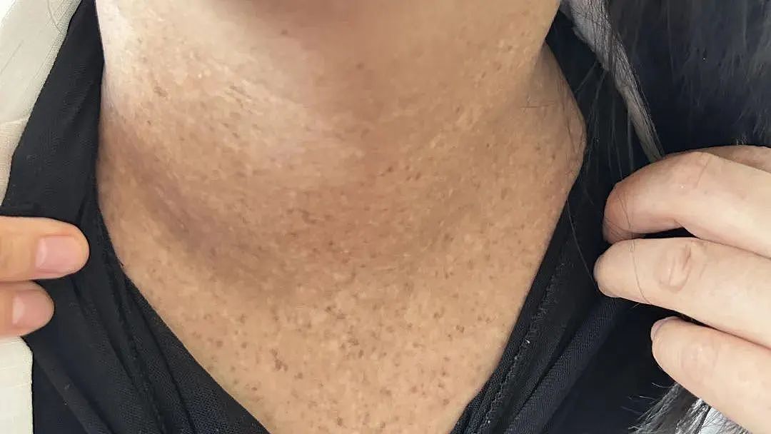 越来越黑!杭州女子脖子总洗不干净,竟是中了“砒霜”之毒!医生:她有个习惯……(组图) - 1