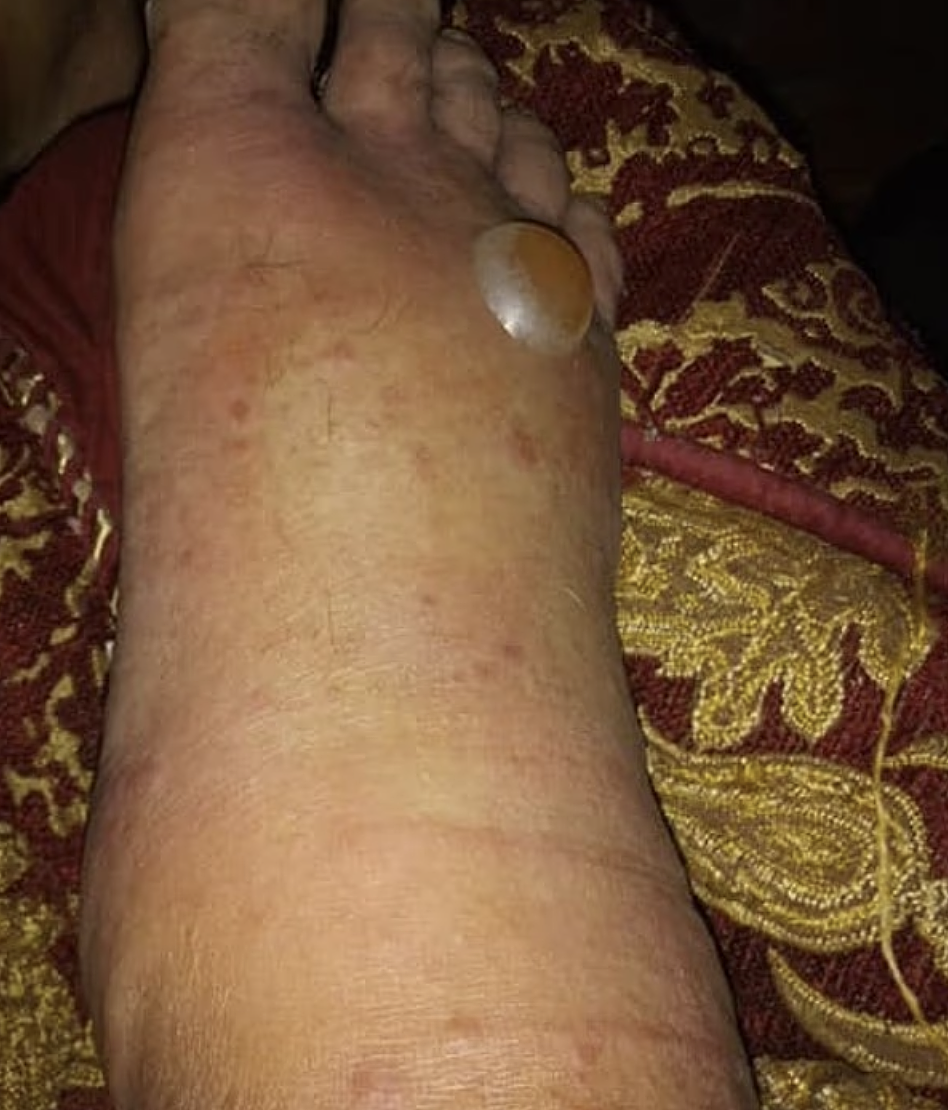 恐怖！ 北美爆发“吃人细菌“疫情，近百人感染，10人已死！ 数小时就夺命，游个泳整条腿坏死（组图） - 2