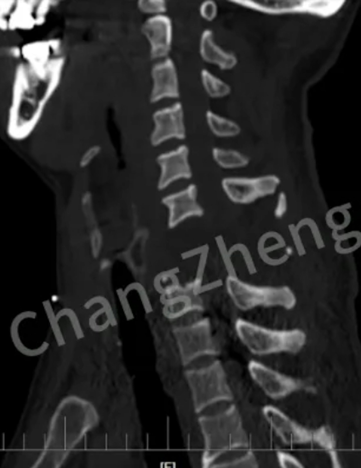 全球罕见！上海医生救回“身首离断”患者，手术难度堪比登天（组图） - 3
