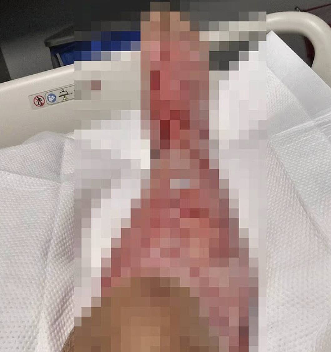 恐怖！ 北美爆发“吃人细菌“疫情，近百人感染，10人已死！ 数小时就夺命，游个泳整条腿坏死（组图） - 3