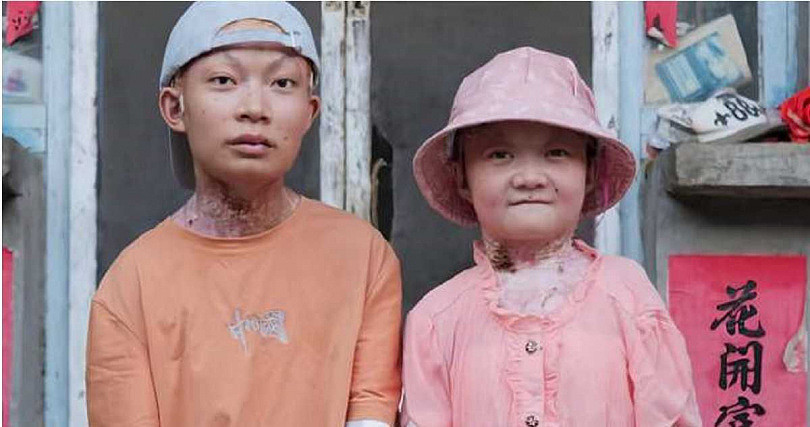 皮肤脆如蝶翼！从出生到离世皆与病魔相伴，“蝴蝶宝宝”病逝弟弟同样受折磨（组图） - 3