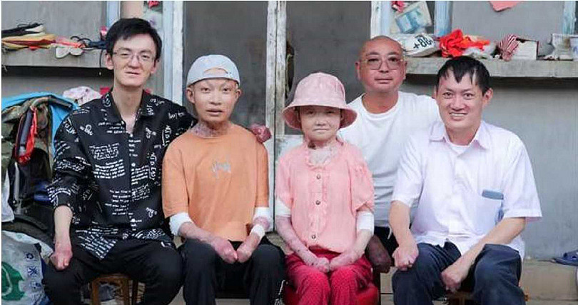 皮肤脆如蝶翼！从出生到离世皆与病魔相伴，“蝴蝶宝宝”病逝弟弟同样受折磨（组图） - 2