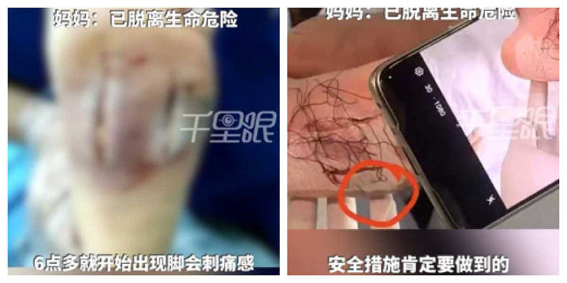 福建6岁童沙滩赤脚踩死鱼，感染海洋无声杀手创伤弧菌险截肢（组图） - 1
