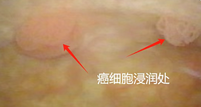 不痛不痒一查竟是癌？这5种“悄无声息”的癌症，很多发现已是晚期（组图） - 1