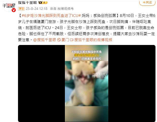 福建6岁童沙滩赤脚踩死鱼，感染海洋无声杀手创伤弧菌险截肢（组图） - 2