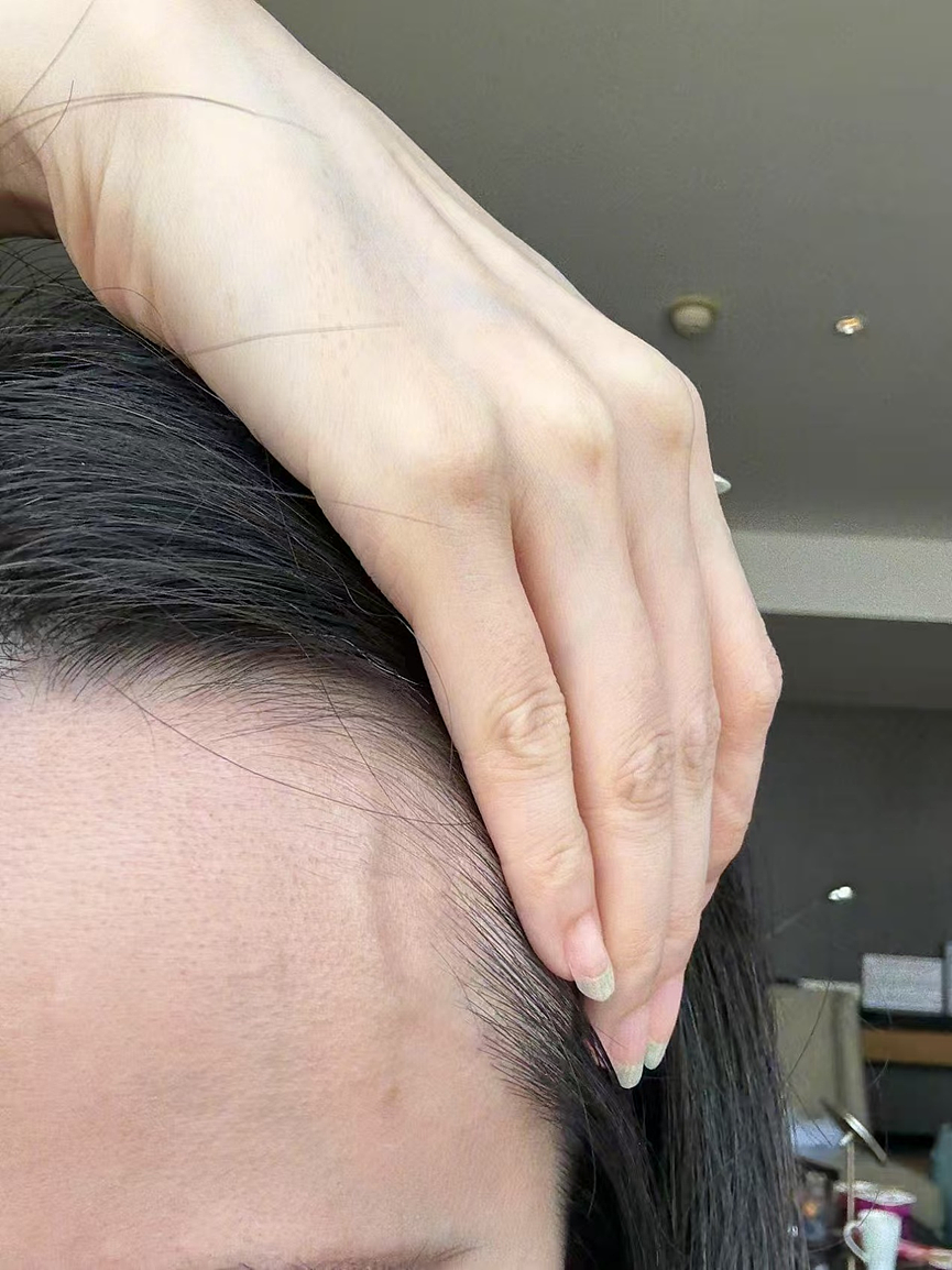 伸个懒腰手掌流血？张靓颖自曝患病，已开始惜命！“这种病很隐匿易被误诊……”（视频/组图） - 3