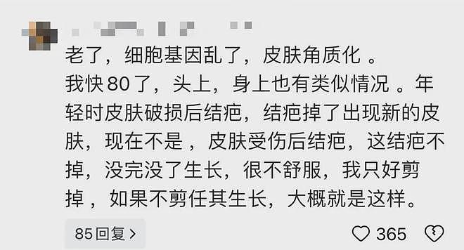 太狠了！98岁老人拿起剪刀，居然把自己身上的这东西剪掉了！医生傻眼了（组图） - 10