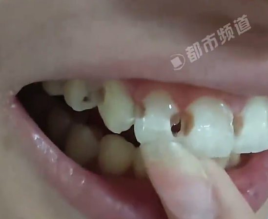 牙缝蛀成洞！女子戴牙套5年烂8颗牙，医生一听洁牙习惯超无奈（组图） - 3