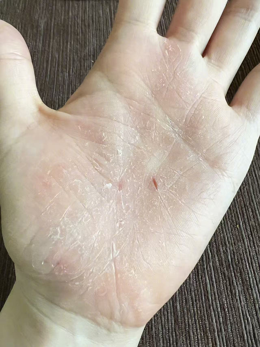 伸个懒腰手掌流血？张靓颖自曝患病，已开始惜命！“这种病很隐匿易被误诊……”（视频/组图） - 2