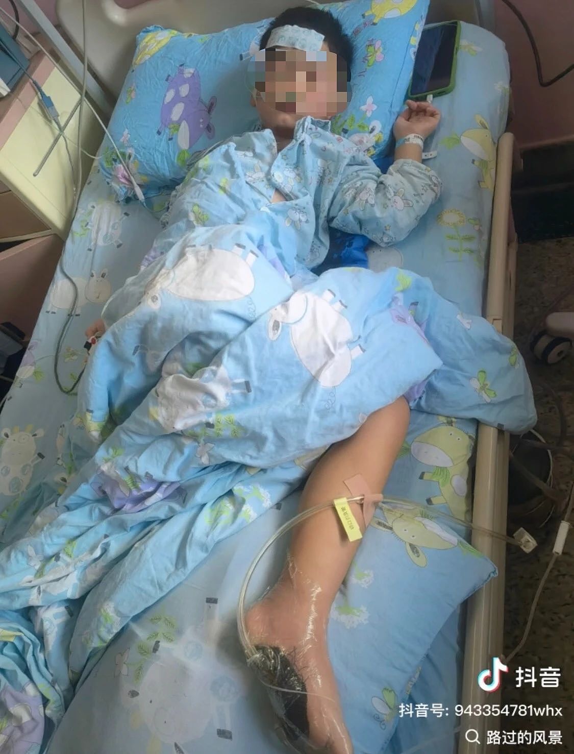 6岁男童沙滩光脚踩到死鱼,第二天高烧晕倒紧急送进ICU!最新消息传来,“脚保住了不用截肢……”(组图) - 1