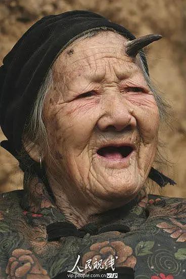 太狠了！98岁老人拿起剪刀，居然把自己身上的这东西剪掉了！医生傻眼了（组图） - 4
