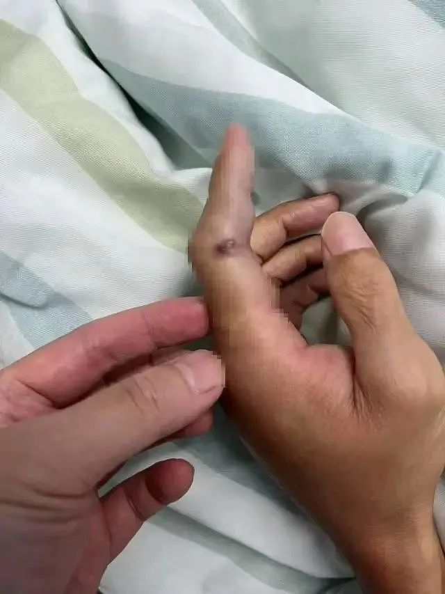6岁男孩沙滩光脚踩到死鱼次日紧急送进ICU，医生提醒：警惕这种“海鲜刺客”，死亡率最高56%（组图） - 4