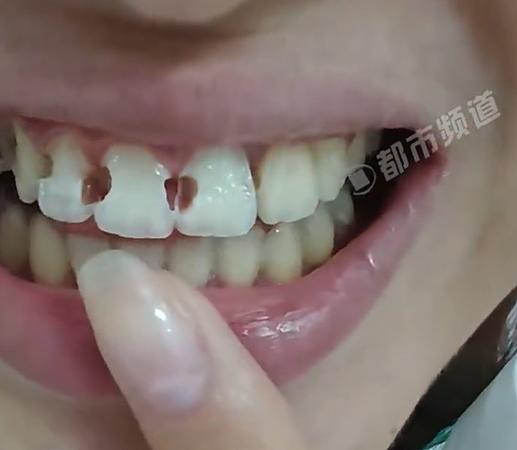 牙缝蛀成洞！女子戴牙套5年烂8颗牙，医生一听洁牙习惯超无奈（组图） - 2