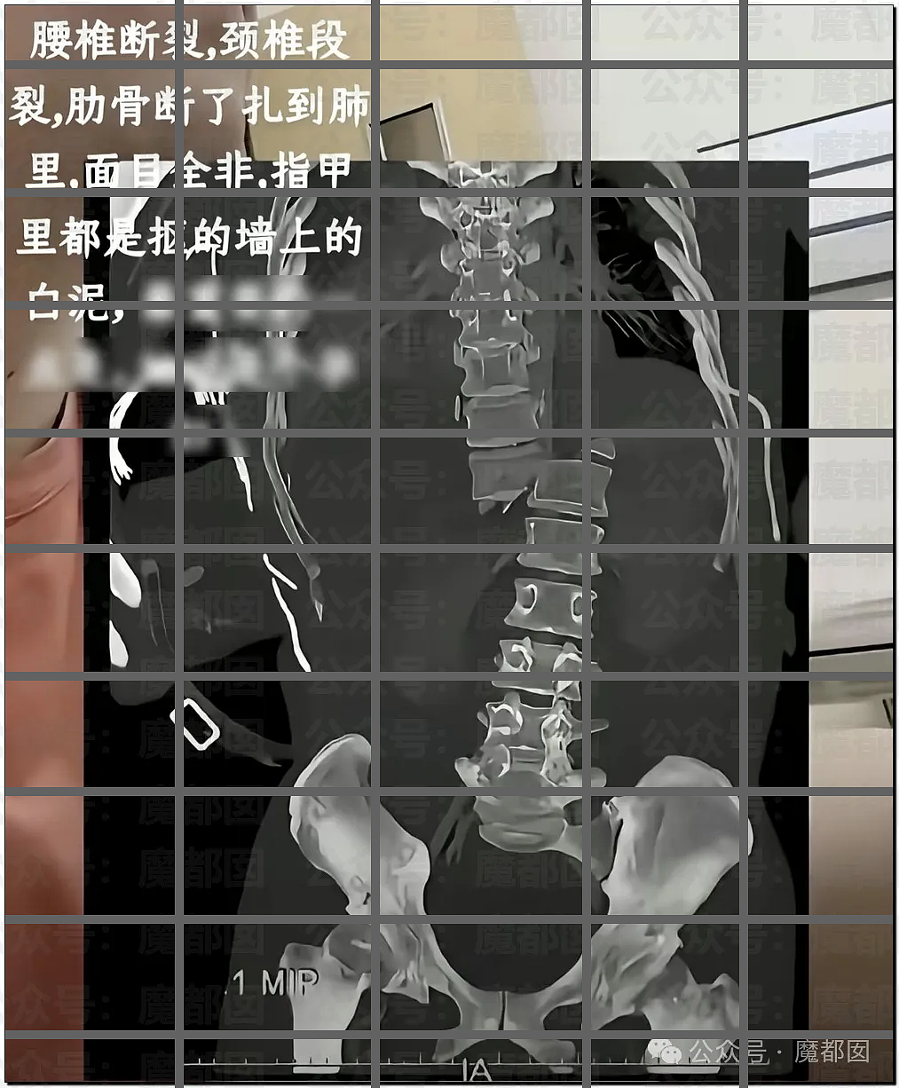 触目惊心！河北25岁宝妈被家暴致