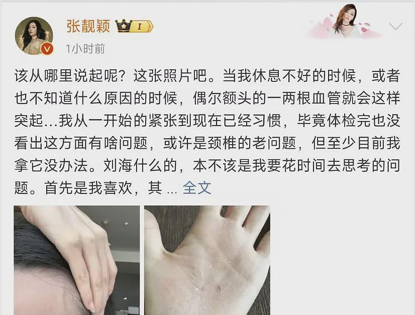 张靓颖患上罕见怪病？手心爆裂、一伸懒腰就流血（组图） - 1