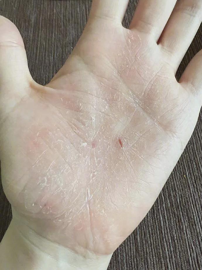 张靓颖患上罕见怪病？手心爆裂、一伸懒腰就流血（组图） - 3