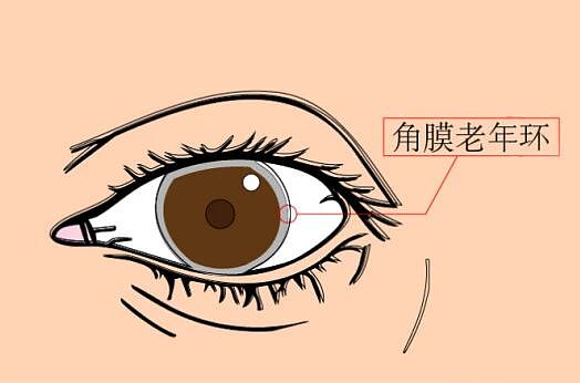 血脂超标的中青年，老了以后会发生什么？（组图） - 8