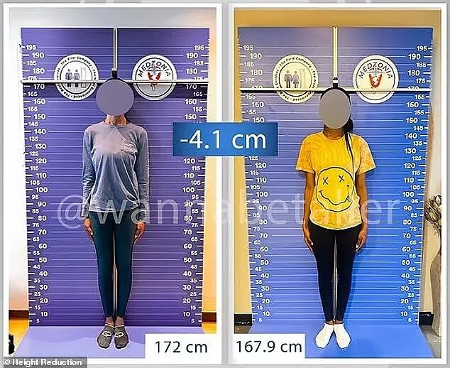 女生嫌太高找不到对象，冒险去切腿... 搞断骨增矮？（组图） - 1