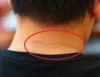 皮肤的6种特殊变化,可能是“癌症”信号(组图) - 2